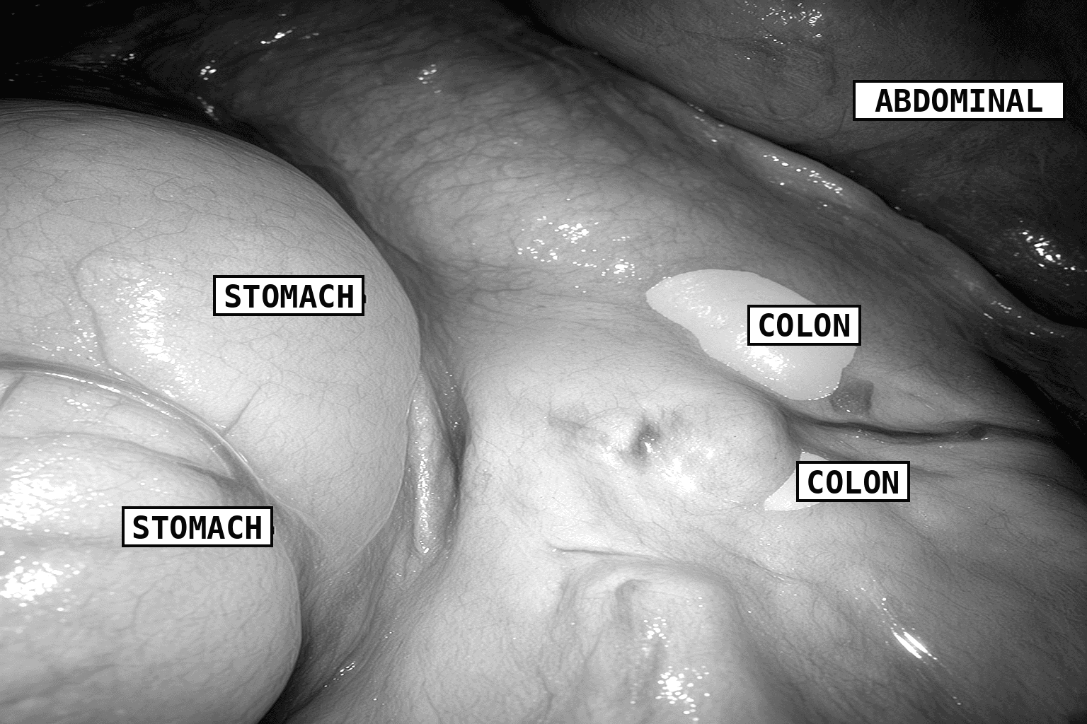 Laparoscopic frame with the model's segmentation masks over the stomach, colon and abdominal wall